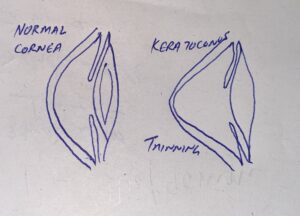 Keratoconus diagram showing the thinning of cornea 